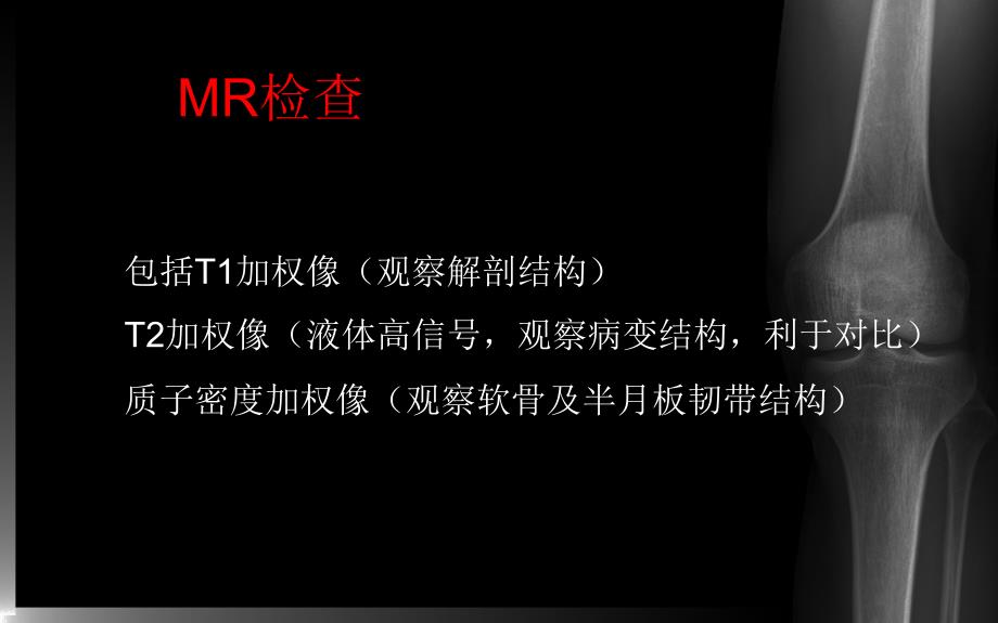 膝关节MRI课件.ppt_第3页