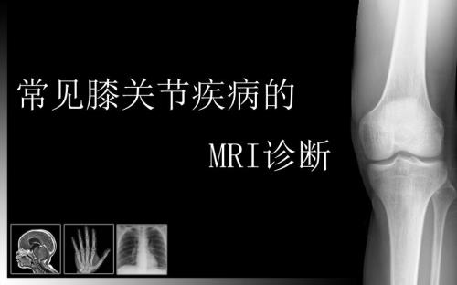 膝关节MRI课件.ppt