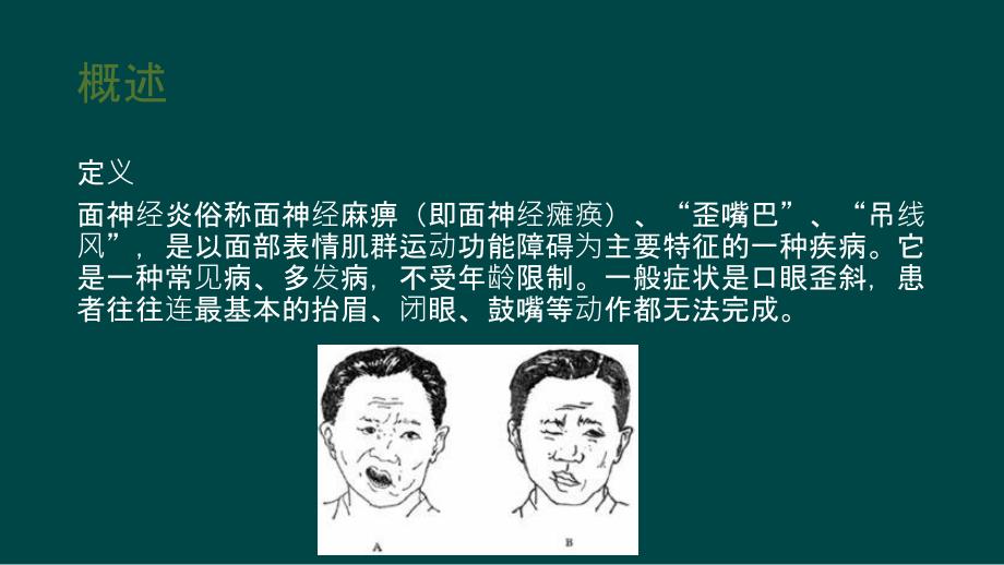 面瘫的护理查房ppt课件.ppt_第3页