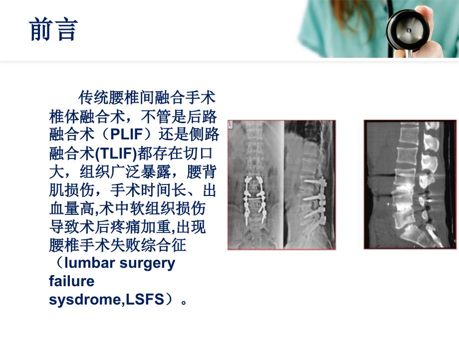 经皮腰椎融合术PPT课件.ppt_第3页