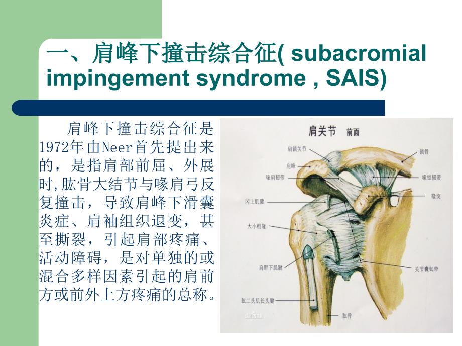 肩峰下撞击综合征.ppt_第3页