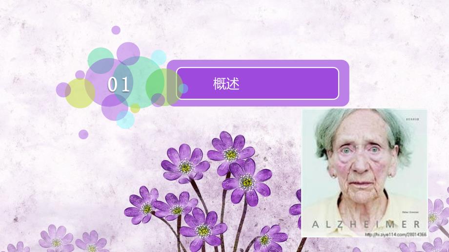 阿尔兹海默症PPT课件.ppt_第2页