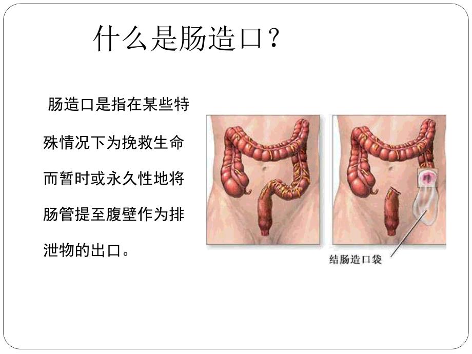 肠造口术课件.ppt_第3页