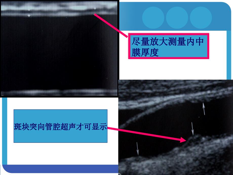 颈动脉斑块超声评价ppt课件.ppt_第3页