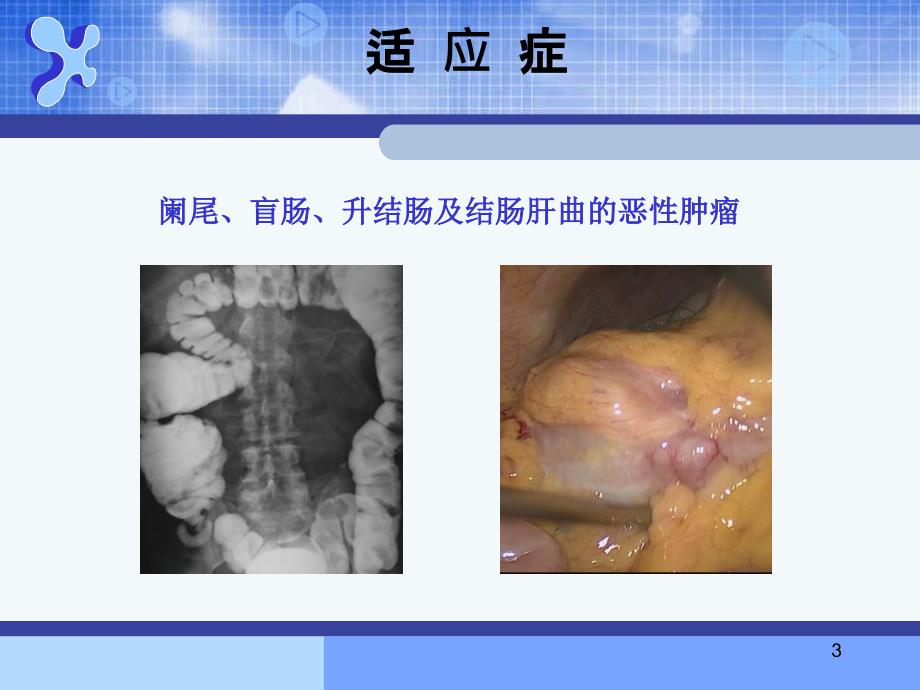 腹腔镜右半结肠切除术ppt课件.ppt_第3页