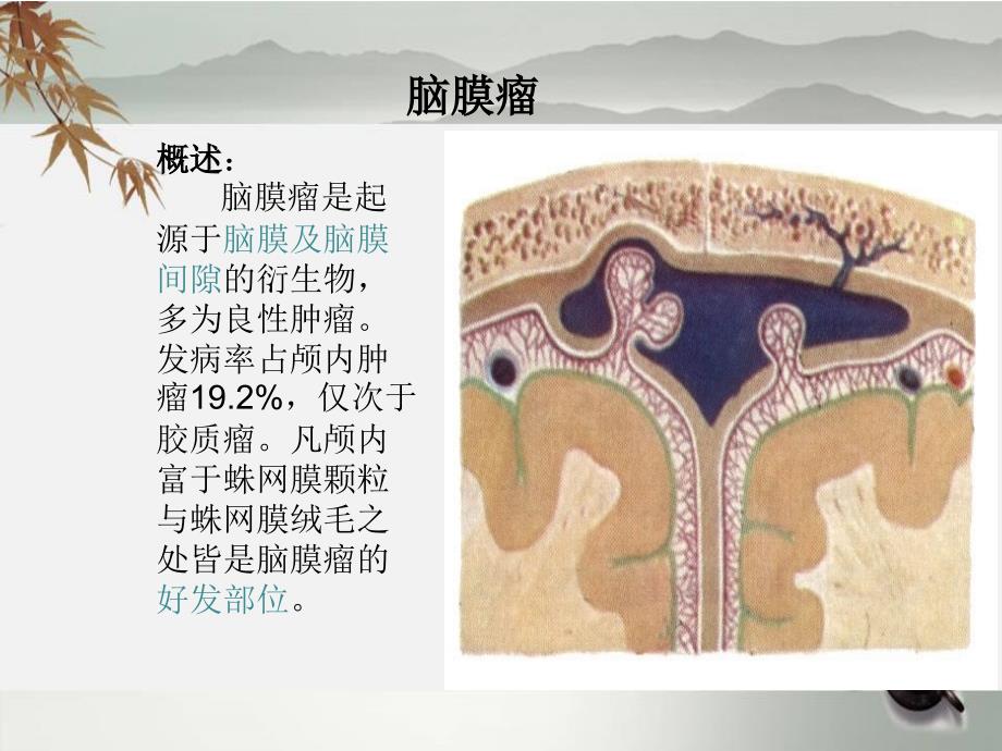 脑膜瘤护理查房课件.ppt_第2页