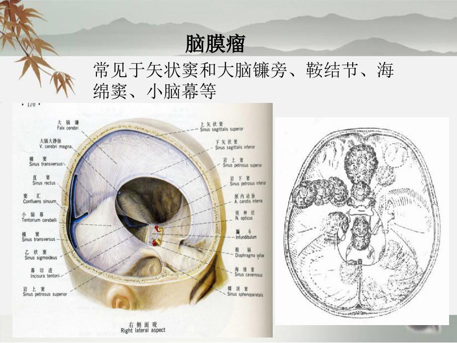 脑膜瘤护理查房课件.ppt_第3页