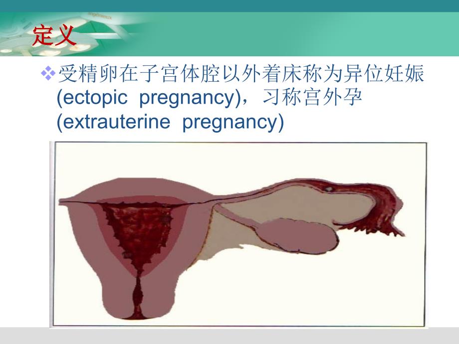 腹腔镜下宫外孕手术的护理配合.ppt_第2页
