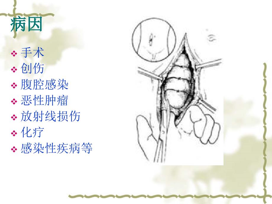 肠瘘病人的护理PPT课件.ppt_第3页