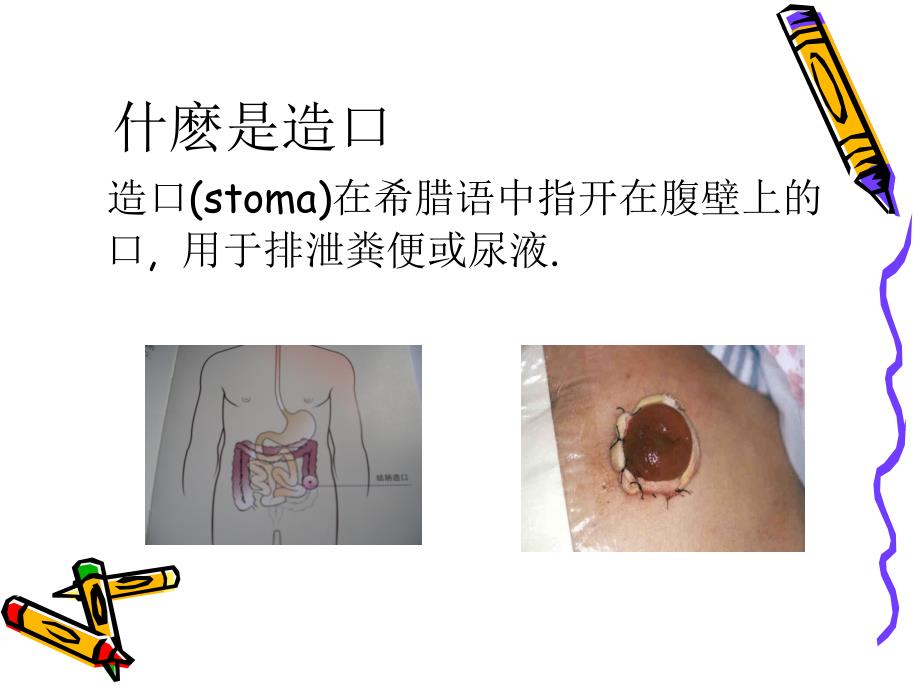 造口护理PPT课件.ppt_第2页