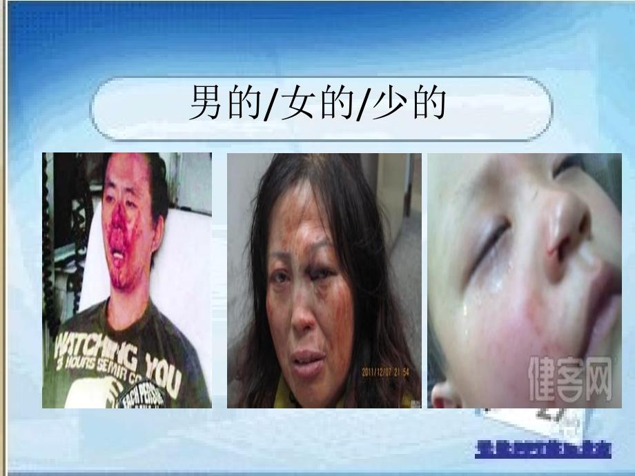 鼻骨骨折课件.pptx_第2页