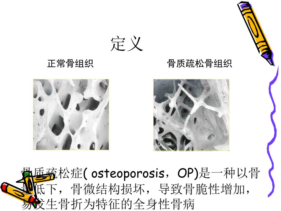 骨质疏松ppt.ppt_第3页