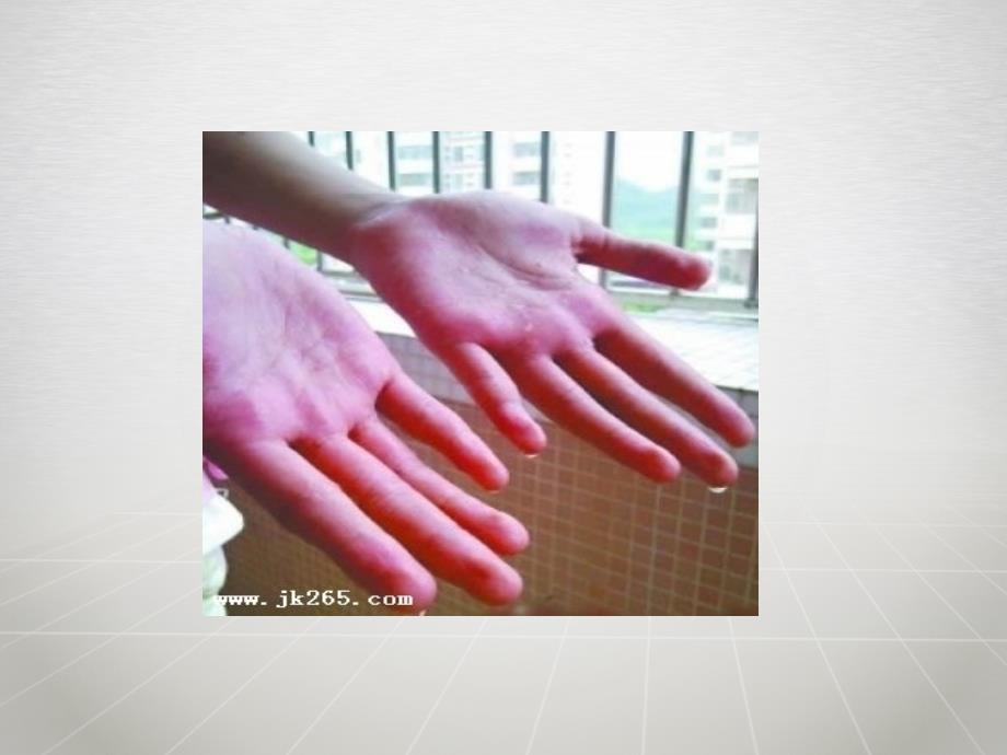 胸腔镜下交感神经切除术后护理资料.ppt_第2页