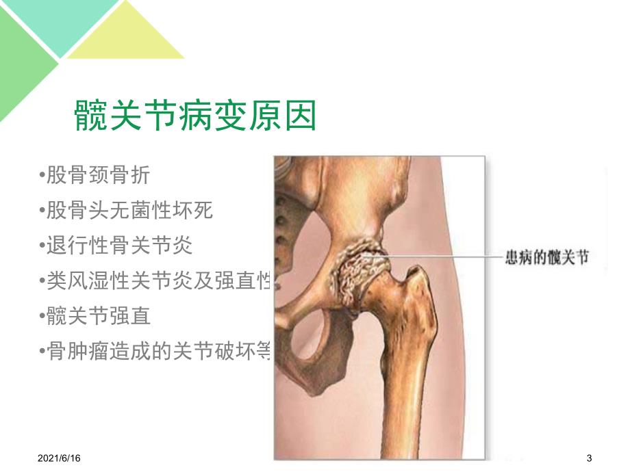 髋关节置换术后护理PPT课件.ppt_第3页