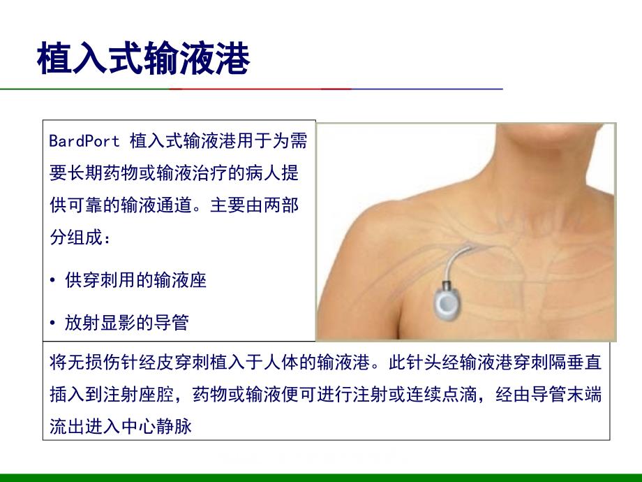 输液港护理查房.ppt_第2页