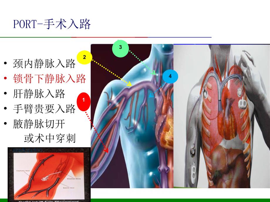 输液港护理查房.ppt_第3页