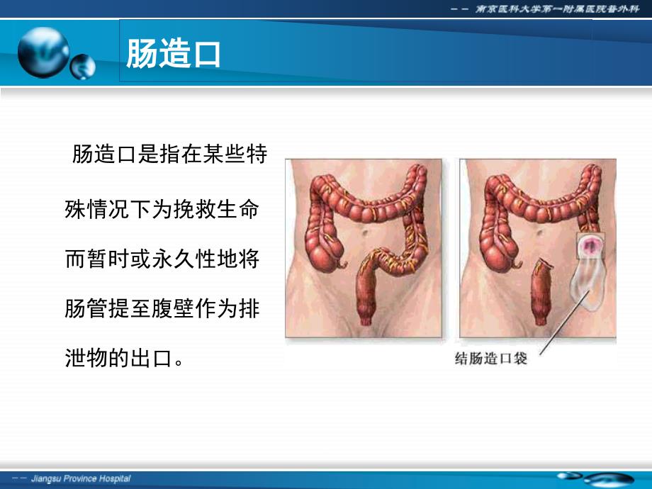 肠造口及其护理PPT课件.ppt_第2页