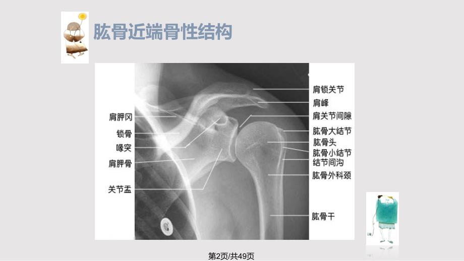 肱骨近端骨折护理查房PPT课件.pptx_第2页