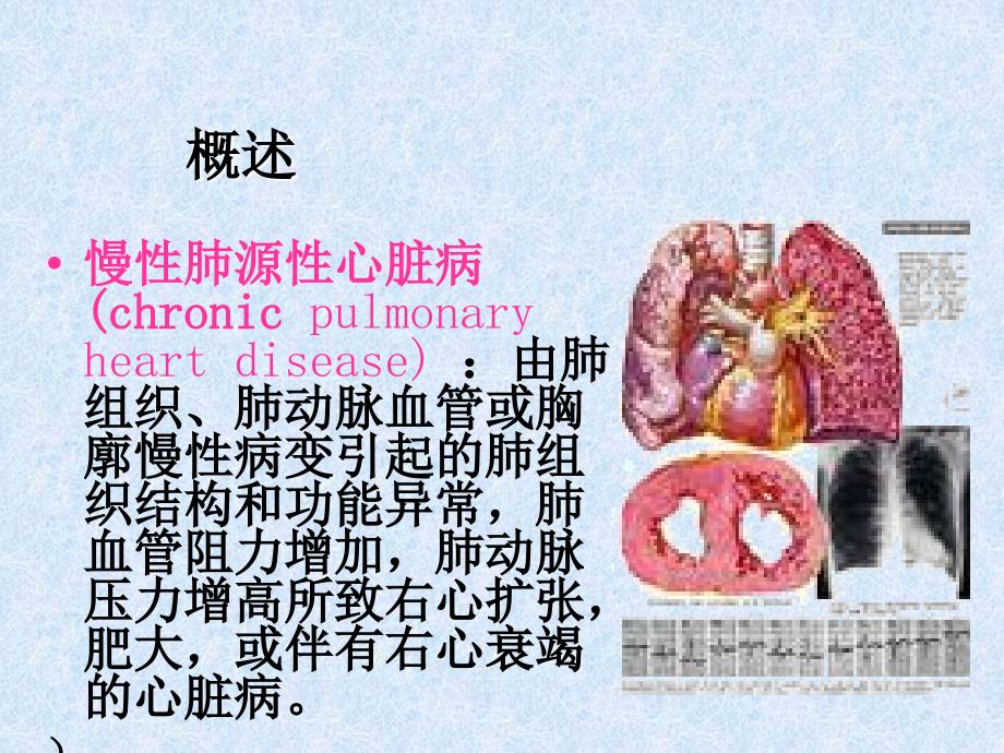 肺心病护理查房PPT课件.ppt_第2页