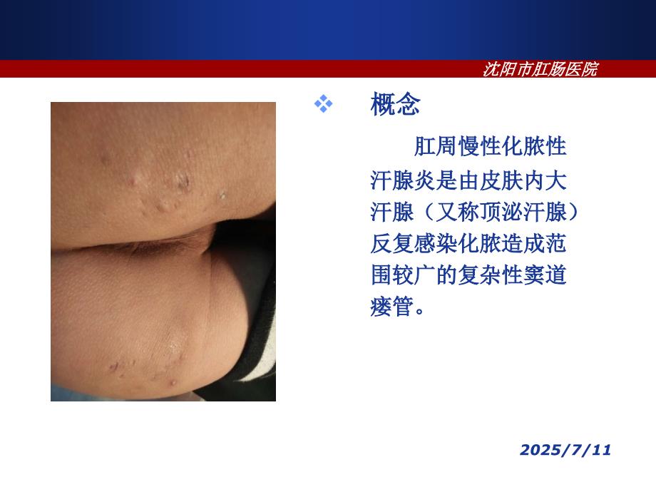 肛周慢性化脓性汗腺炎的诊断与治疗.ppt_第2页
