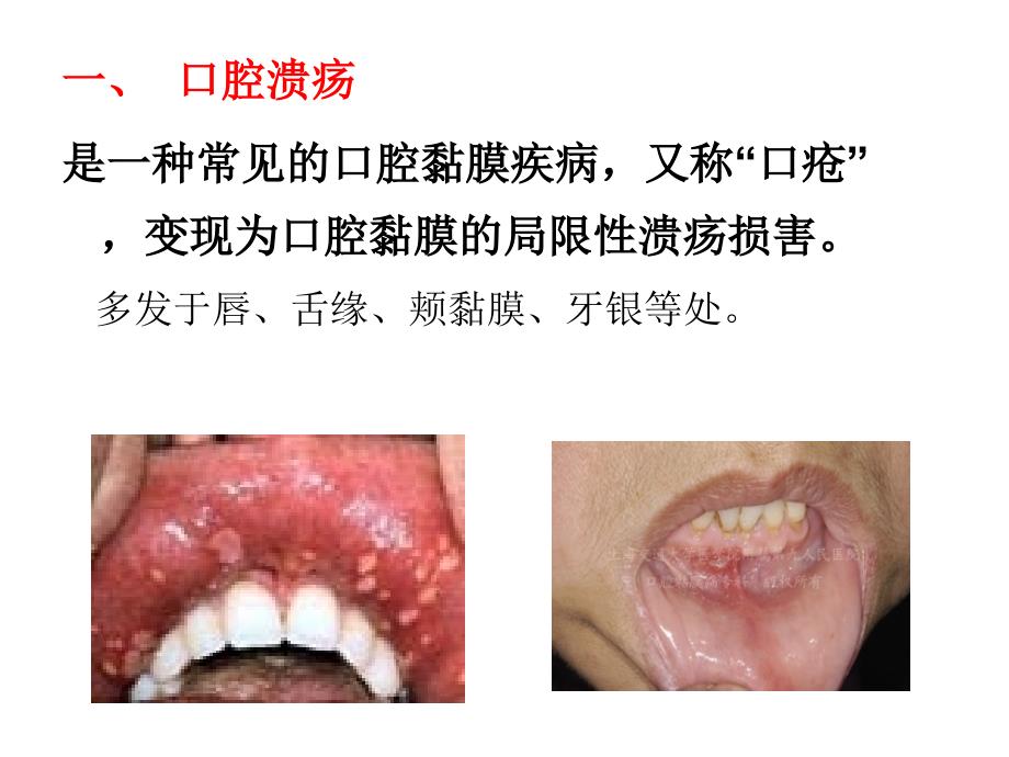 项目五模块二口腔溃疡.ppt_第2页