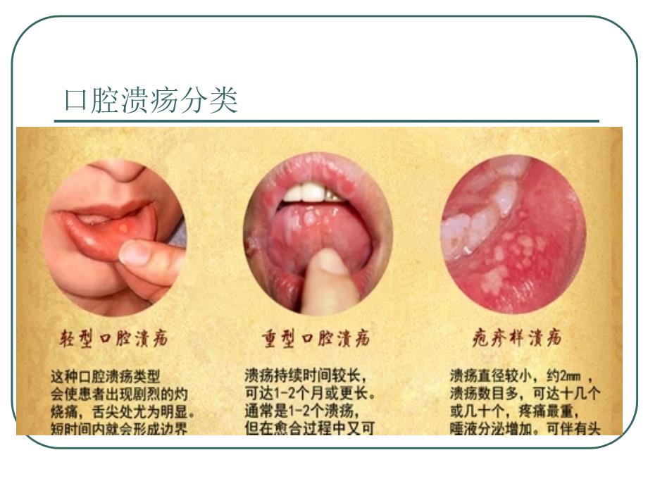 项目五模块二口腔溃疡.ppt_第3页