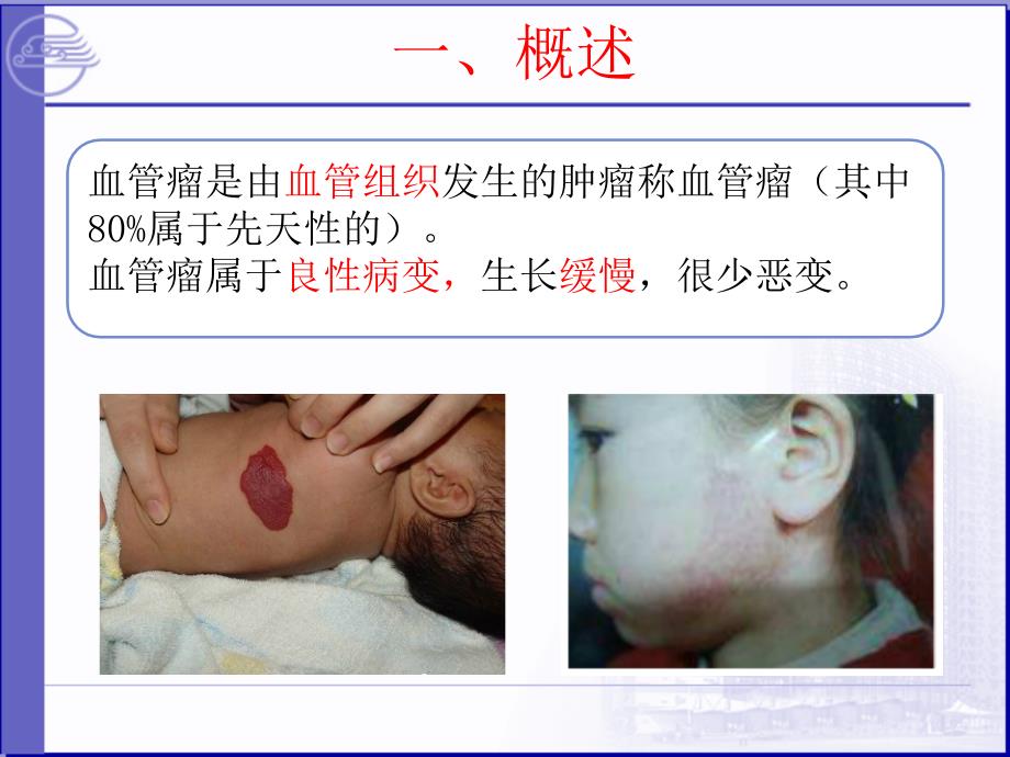 血管瘤的护理PPT课件.ppt_第2页