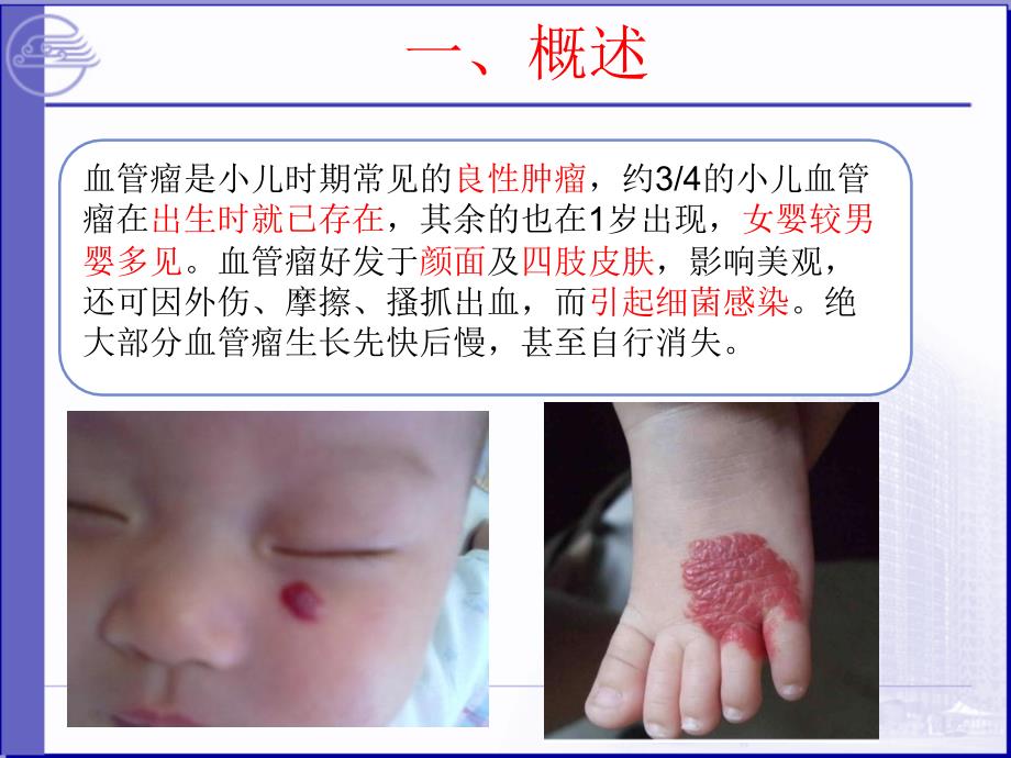 血管瘤的护理PPT课件.ppt_第3页