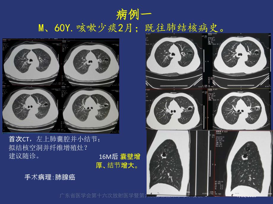 薄壁囊腔型肺癌的影像诊断和鉴别诊断liu.ppt_第2页