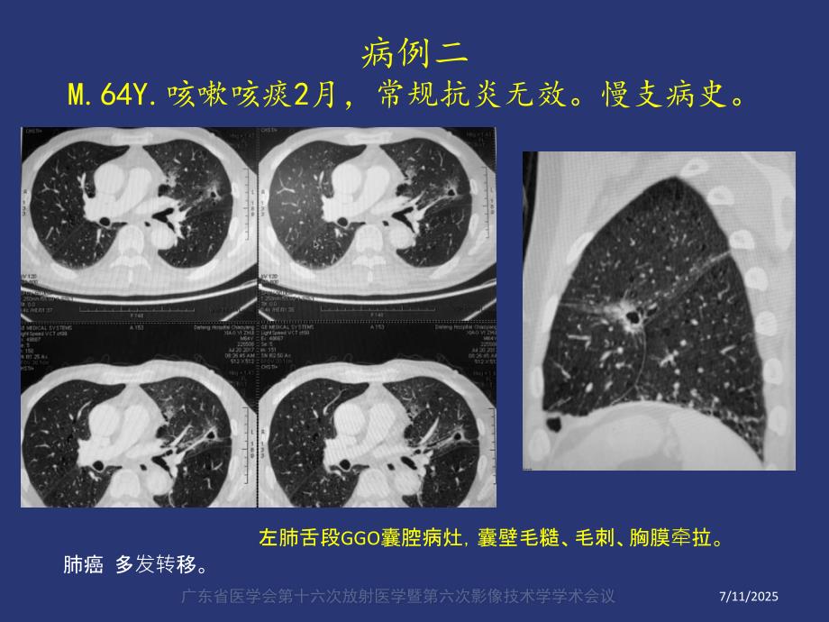 薄壁囊腔型肺癌的影像诊断和鉴别诊断liu.ppt_第3页