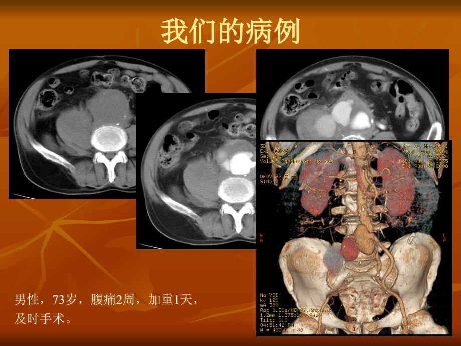 腹主动脉瘤破裂及先兆破裂的CT表现.ppt_第2页