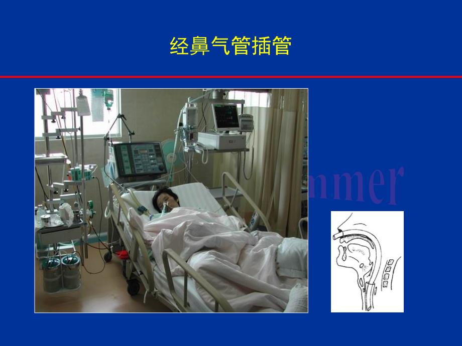 经鼻气管插管PPT课件.ppt_第3页