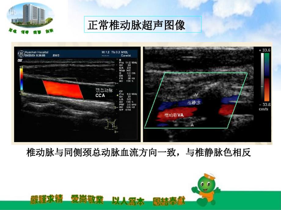 锁骨下动脉盗血课件.ppt_第3页