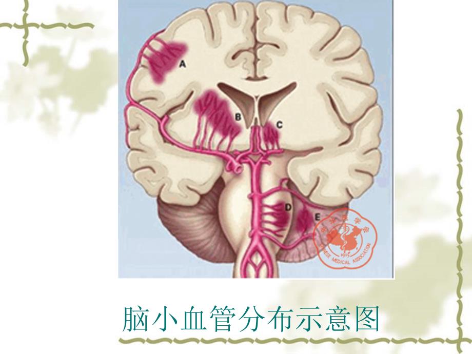 脑小血管病PPT课件.ppt_第3页