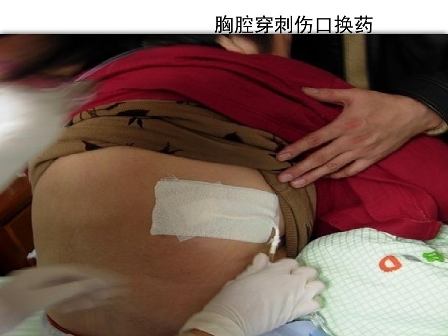胸腔积液的护理措施课件.pptx_第3页