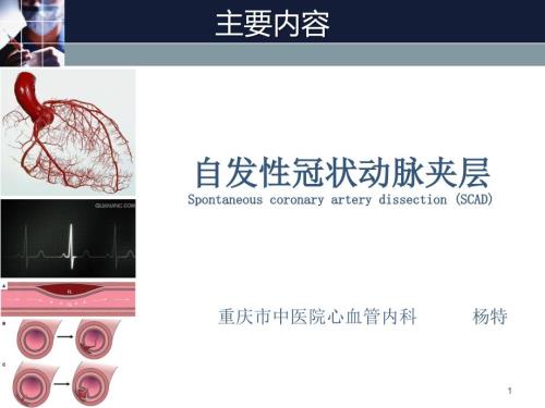 自发冠脉夹层诊疗指南解读.ppt