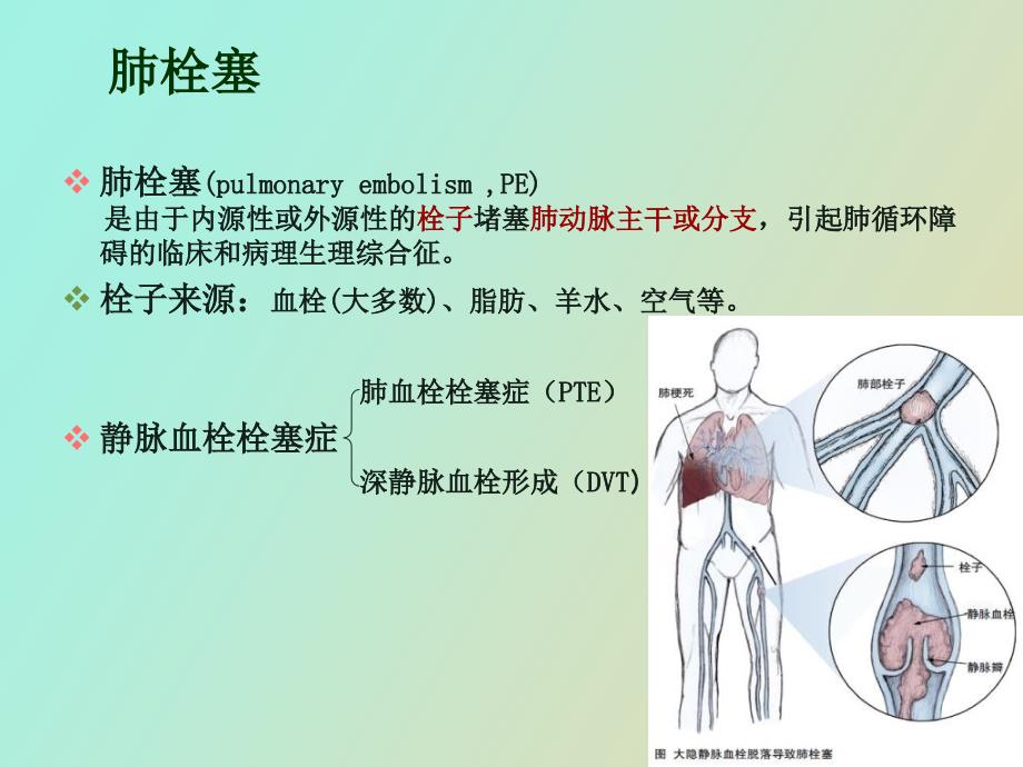 肺栓塞溶栓的护理.ppt_第3页
