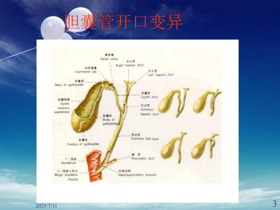胆囊结石伴胆囊炎PPT课件.ppt_第3页