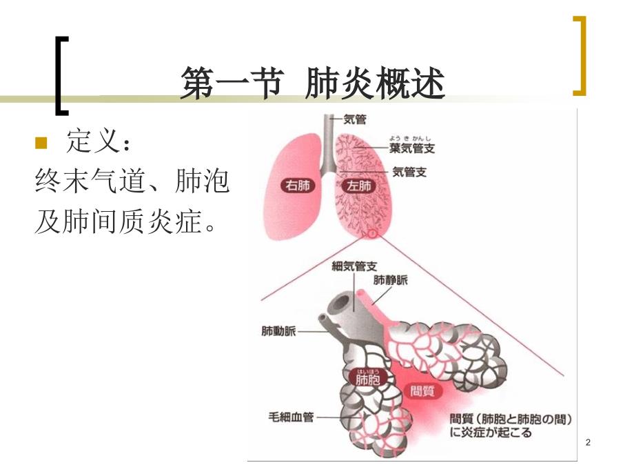 肺炎概述PPT课件.ppt_第2页