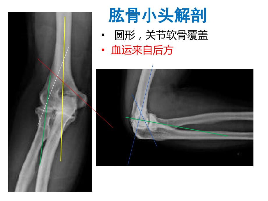 肱骨小头骨折的手术技巧ppt课件.ppt_第2页