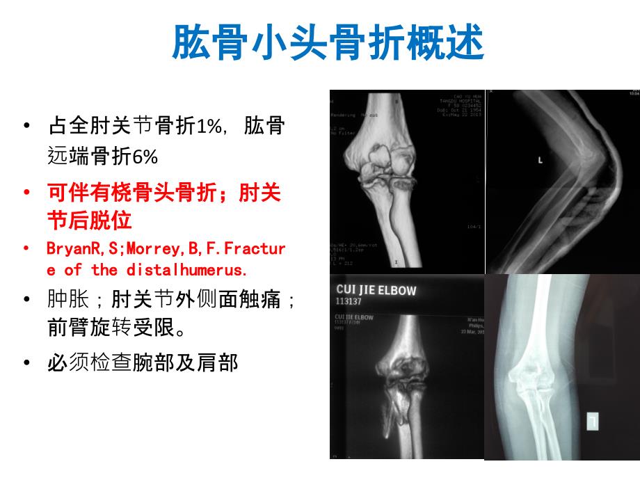 肱骨小头骨折的手术技巧ppt课件.ppt_第3页