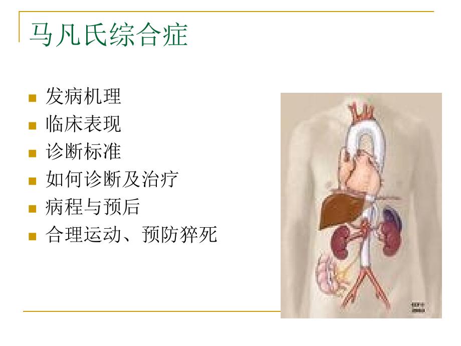 马凡氏综合症.ppt_第2页
