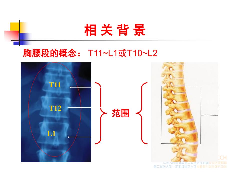 胸腰椎骨折的研究进展.ppt_第2页