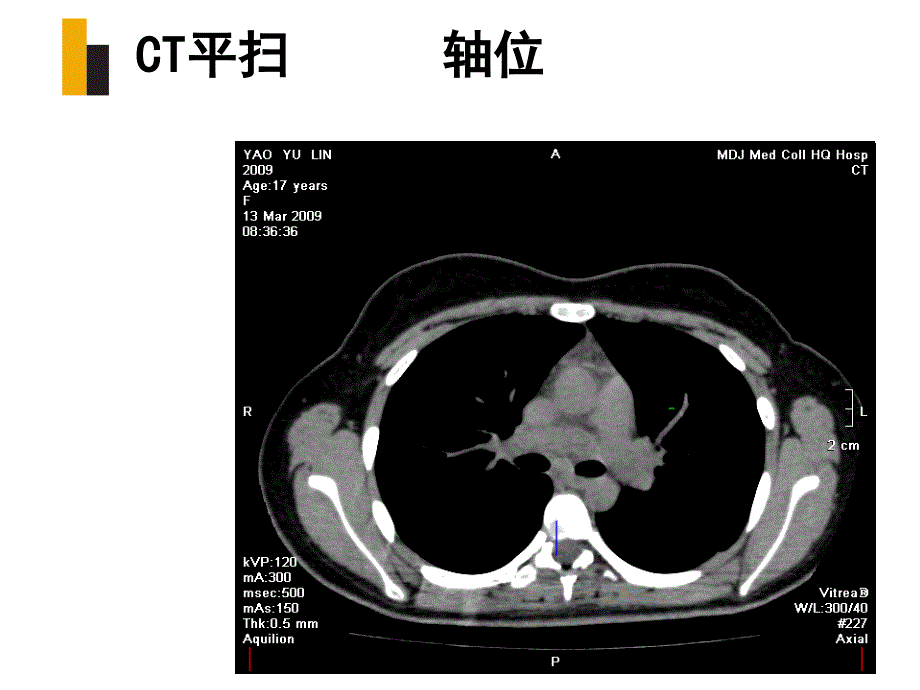 纵隔淋巴结节结核ppt课件.ppt_第3页