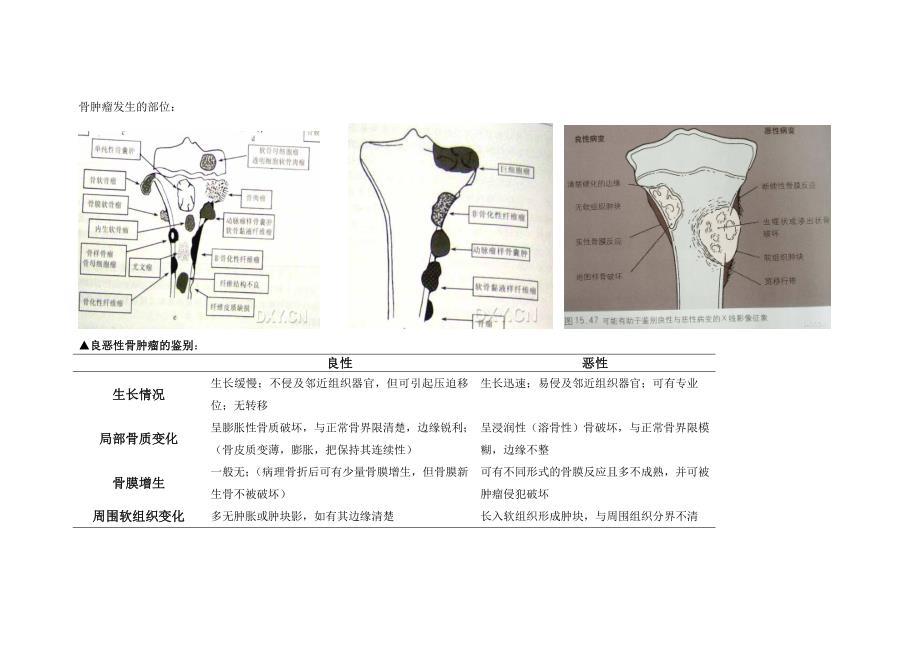 骨肿瘤鉴别诊断.doc_第1页