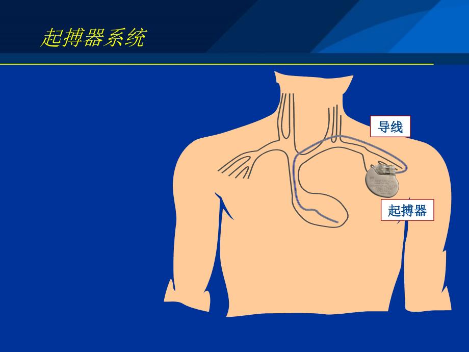 起搏器电极导线介绍.ppt_第2页