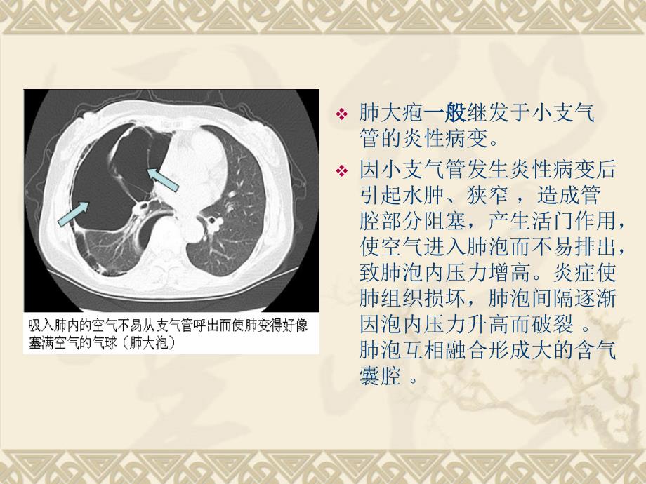 肺大疱的护理PPT课件.ppt_第3页