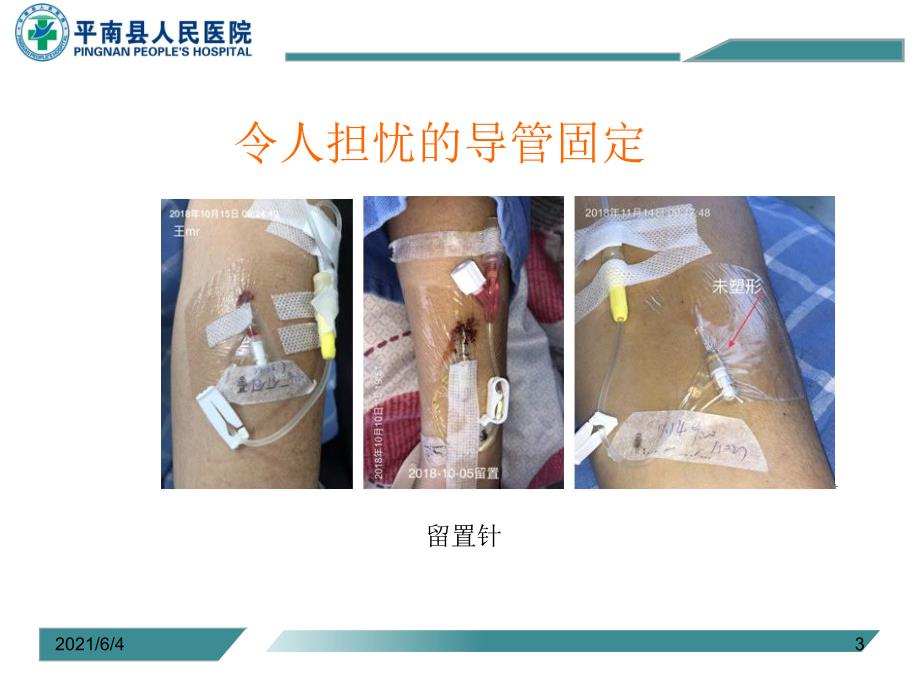 静疗培训常见各种导管的固定方法.ppt_第3页