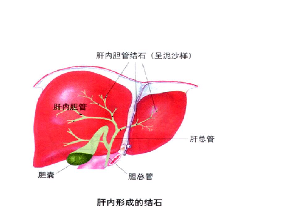 肝内外胆管结石病人的护理ppt课件.ppt_第3页