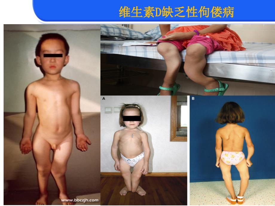 维生素D缺乏性佝偻病.ppt_第3页